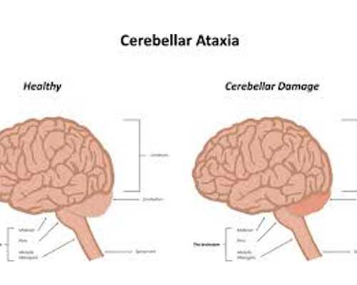 做试管取完卵卵巢胀痛正常吗？试管婴儿取完卵腹部胀怎么办？