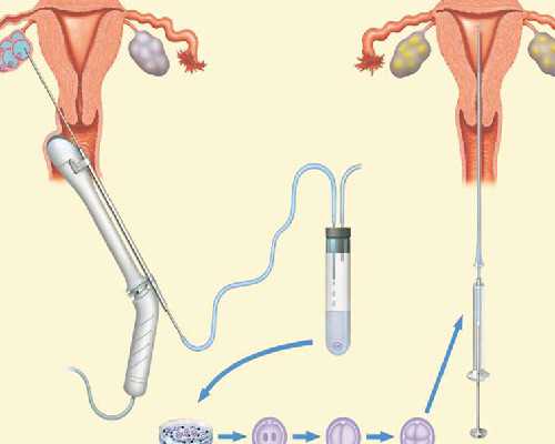 单角子宫做试管成功率高不？单角子宫做试管婴儿成功率多高？